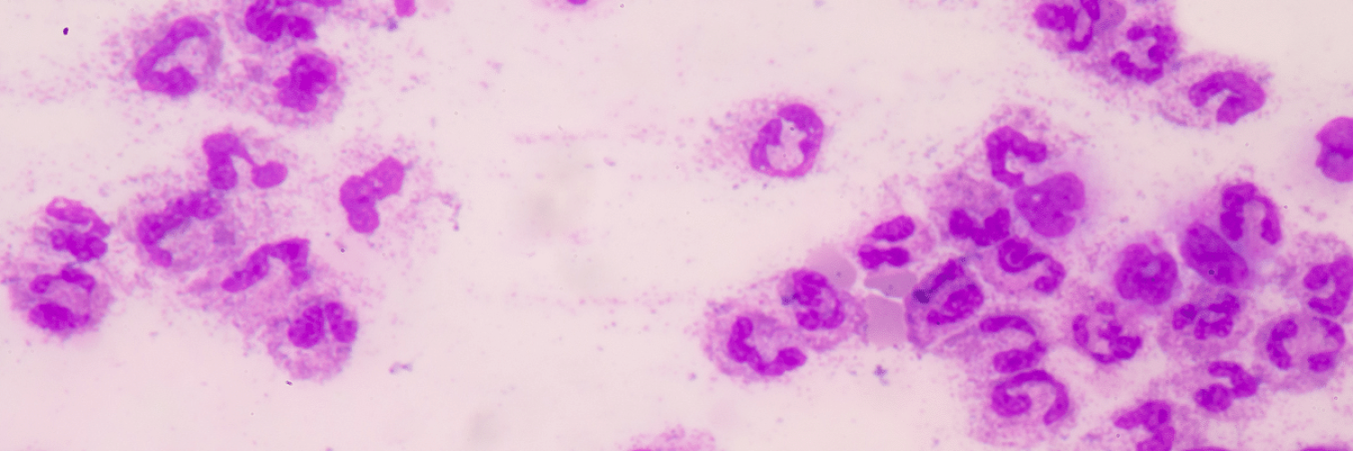 sepsis